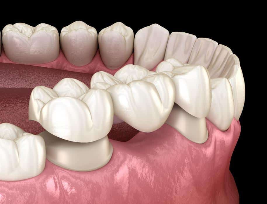 Dental crown procedure illustration showing tooth preparation and ceramic crown placement on gum model.
