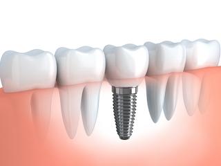 Dental implant diagram showing titanium post placement among natural teeth in gum tissue.
