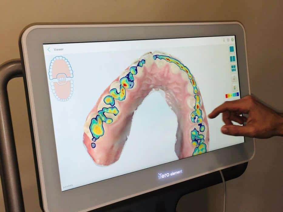 Person pointing to digital dental scan display showing colorful 3D tooth model on screen.