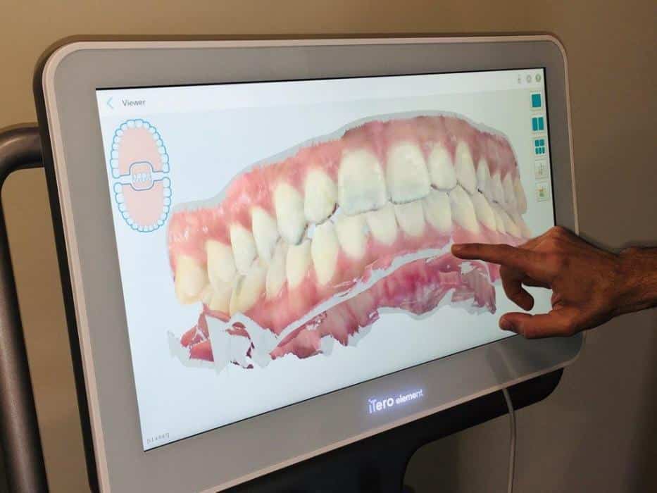 Person pointing at digital display showing dental implant prosthetics model in clinical setting.