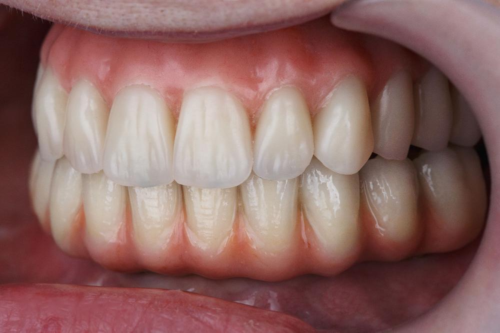 Close-up view of natural, healthy white teeth and gums showing proper dental alignment and oral health.