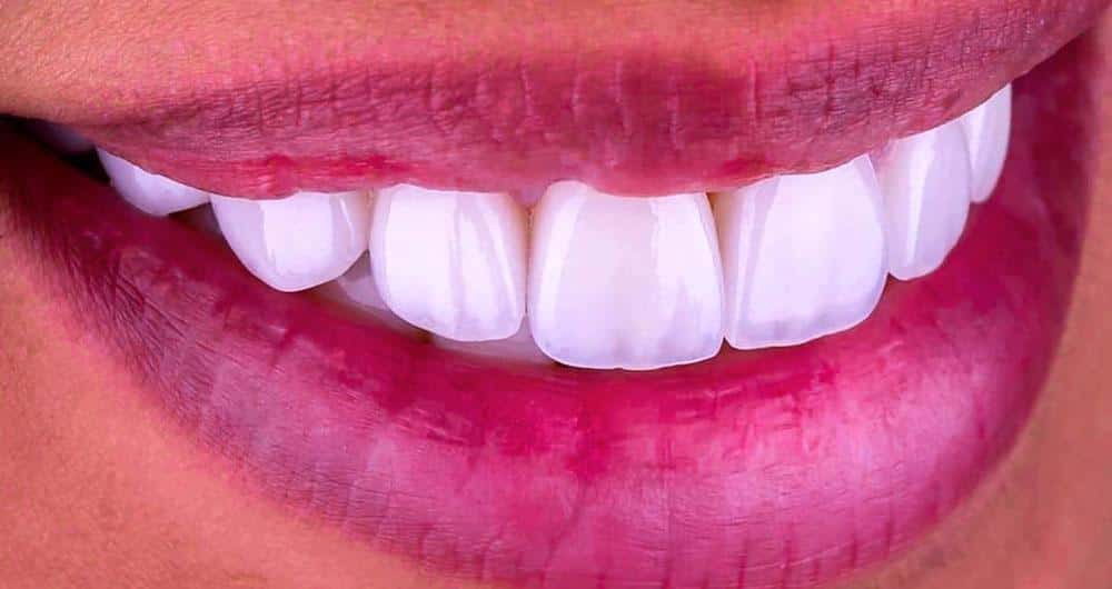 Close-up of a bright white smile showing upper front teeth and pink lips.