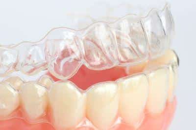 Clear dental aligner tray positioned over model teeth showing orthodontic treatment demonstration
