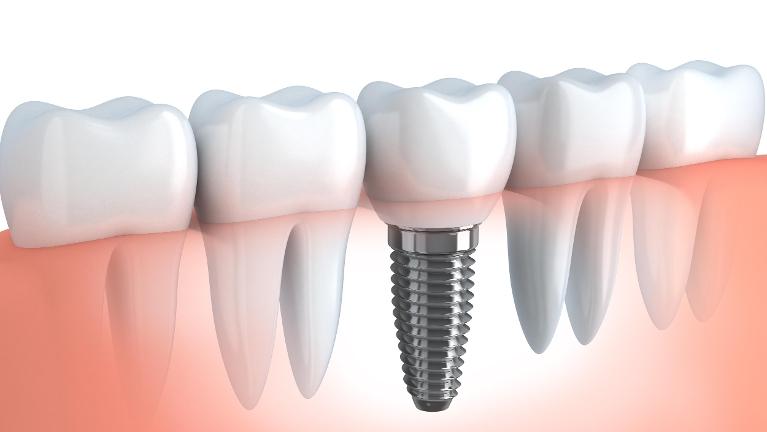 Dental implant illustration showing prosthetic tooth structure integrated into jawbone among natural teeth.