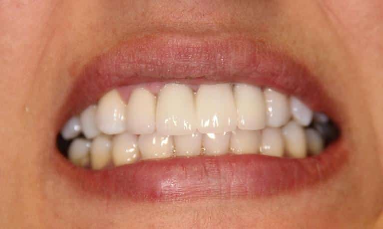 Close-up of person's smile showing upper and lower teeth with visible dental work or restoration.