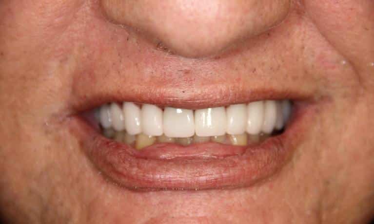 Close-up of person's smile showing white, healthy teeth and natural lip color.