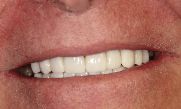 Close-up of a person's smile showing white dental crowns or veneers on upper teeth.