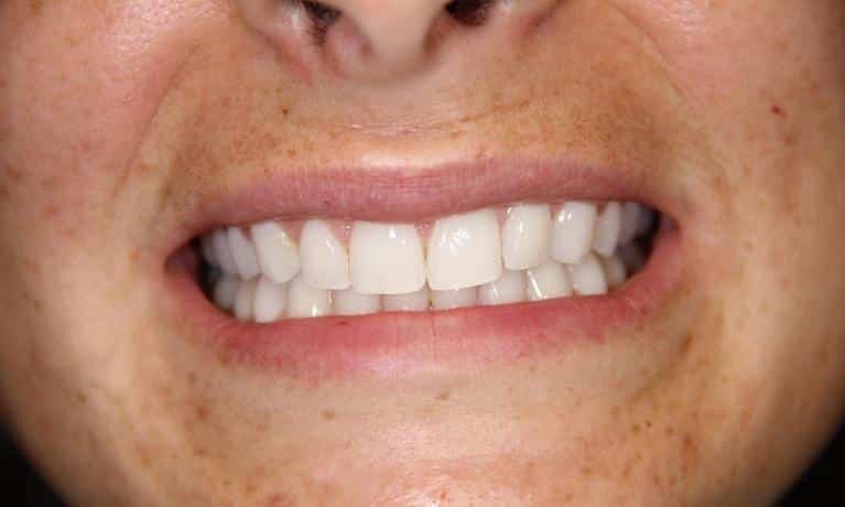 Close-up of person's smile showing white, straight teeth and healthy gums