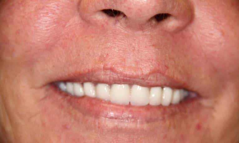 Close-up of person's lower face displaying bright white teeth and smile