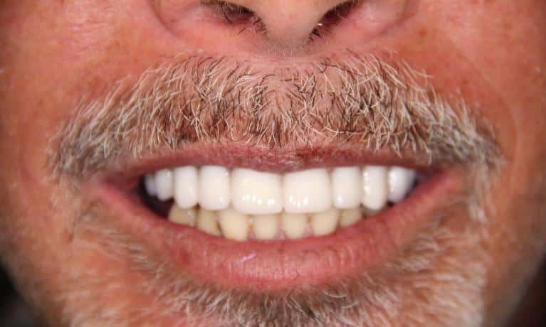 Close-up of man's smile showing white teeth and facial hair, dental care example