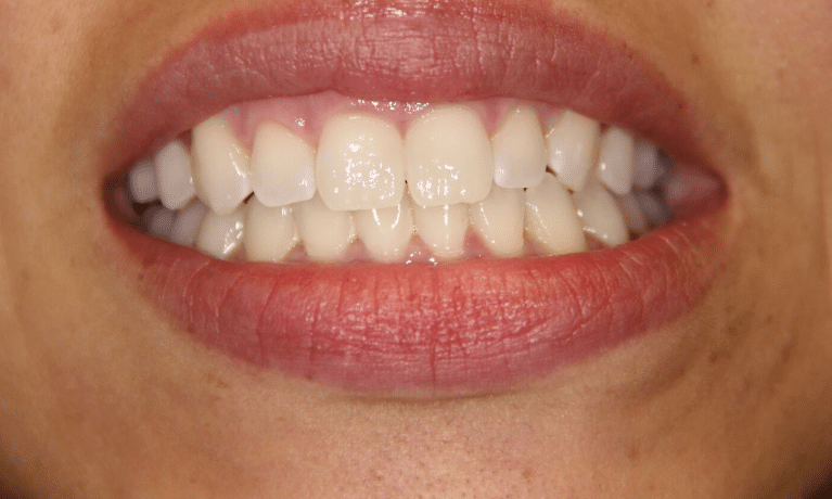 Close-up of a person's smile showing healthy, well-aligned white teeth and pink gums.
