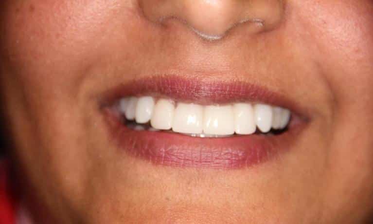 Close-up of a person's smile showing bright, white teeth and healthy gums.