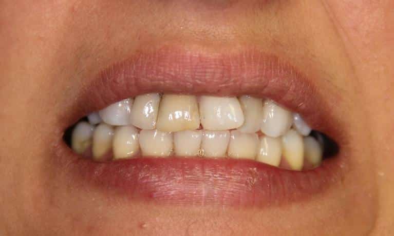 Close-up of teeth showing discoloration and misalignment requiring dental care