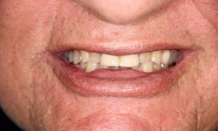 Close-up of person's smile showing upper and lower teeth and lips.