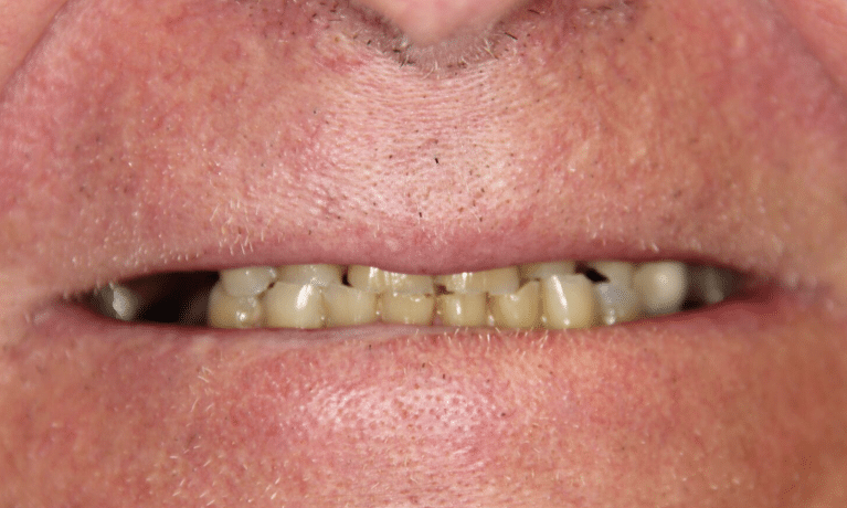 Close-up of discolored and misaligned upper teeth showing dental health concerns requiring professional care.