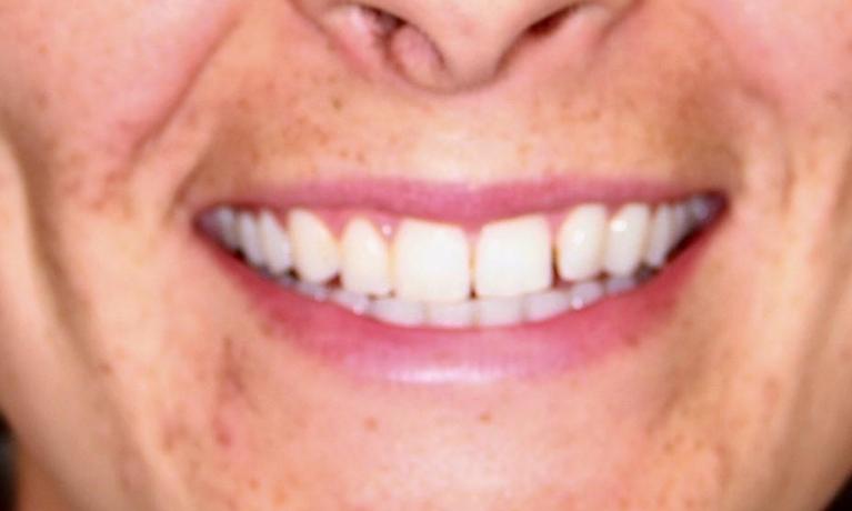Close-up of person smiling, displaying white, healthy teeth and bright smile.