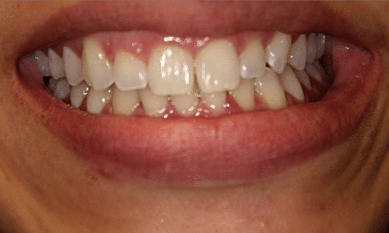 Close-up of upper and lower teeth showing dental work and natural tooth coloration in mouth.
