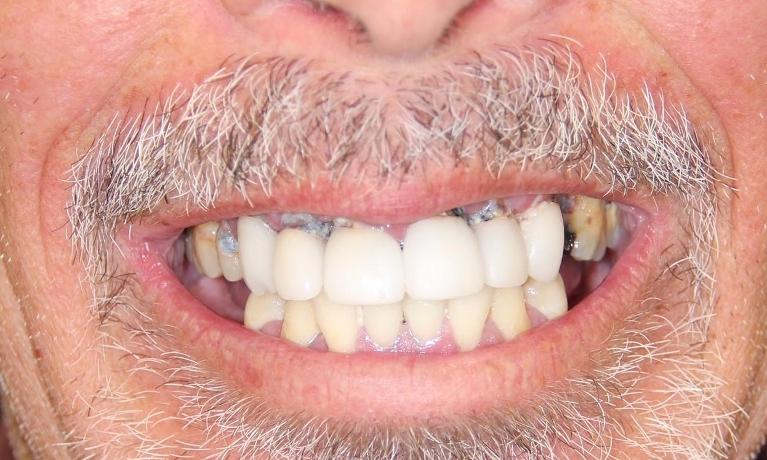 Close-up of smiling male mouth displaying white teeth and dental work results.