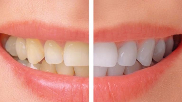 Before and after teeth whitening comparison showing yellowed teeth versus bright white teeth.