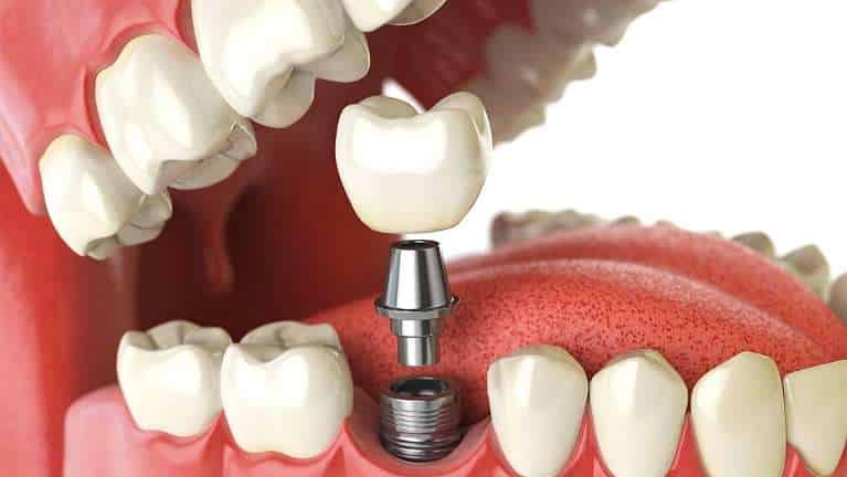 Dental implant diagram showing titanium post fixture between natural teeth in jawbone model.