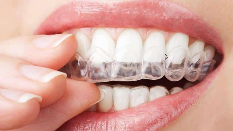 Close-up of person inserting clear dental aligner tray into mouth for orthodontic treatment.