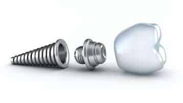 Dental implant components displayed: screw, abutment, and crown prosthetic tooth.