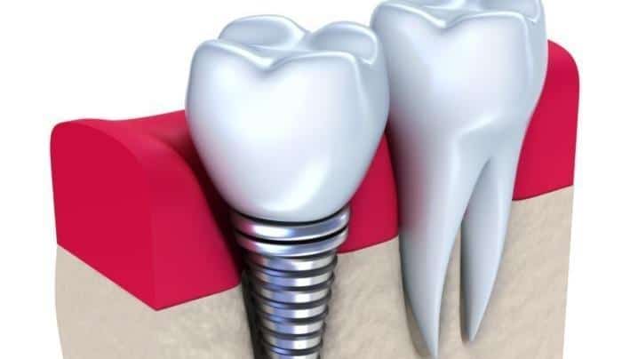 3D dental implant illustration showing titanium screw, crown, and natural tooth comparison on gum model.