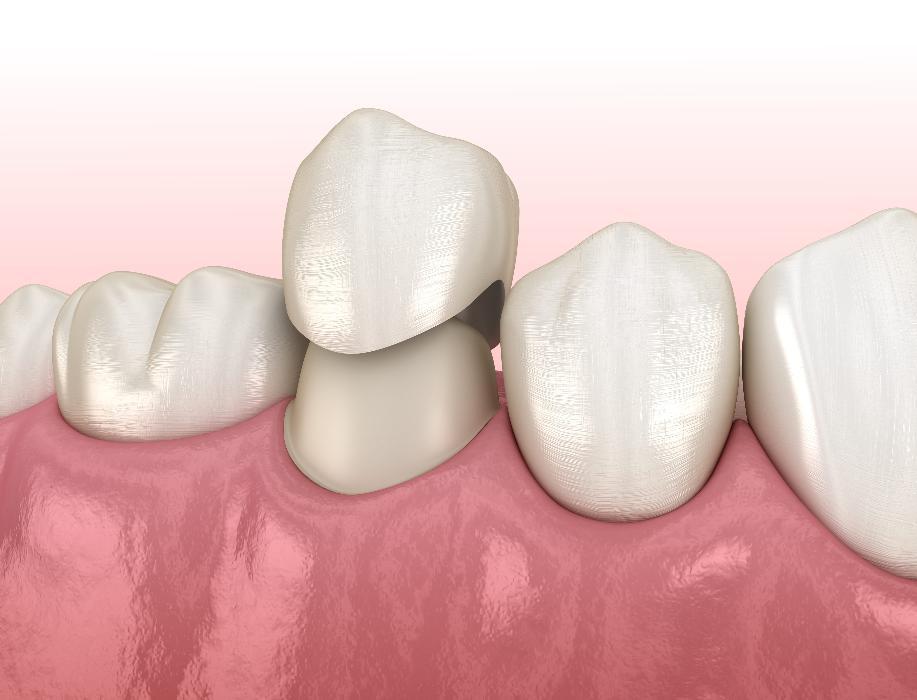 Dental crowns displayed on pink gum model showing tooth restoration procedure
