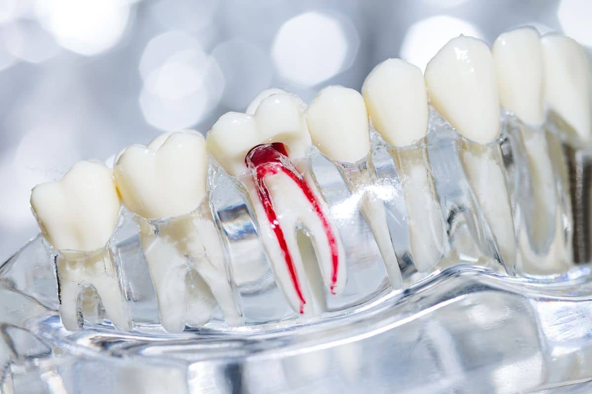 root canal treatments procedure