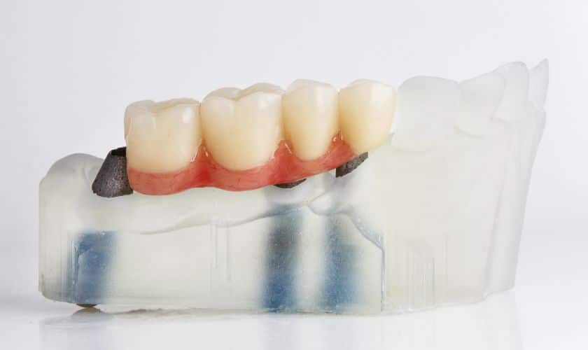 Dental Bridges in Loxahatchee