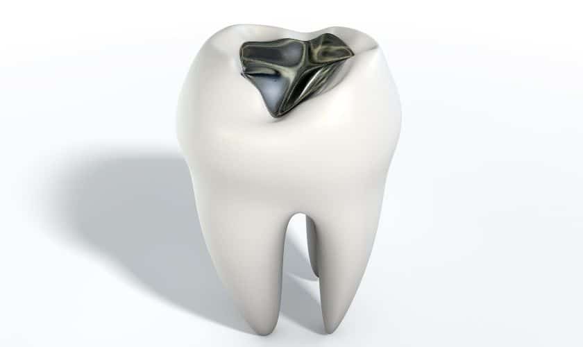 tooth colored filling