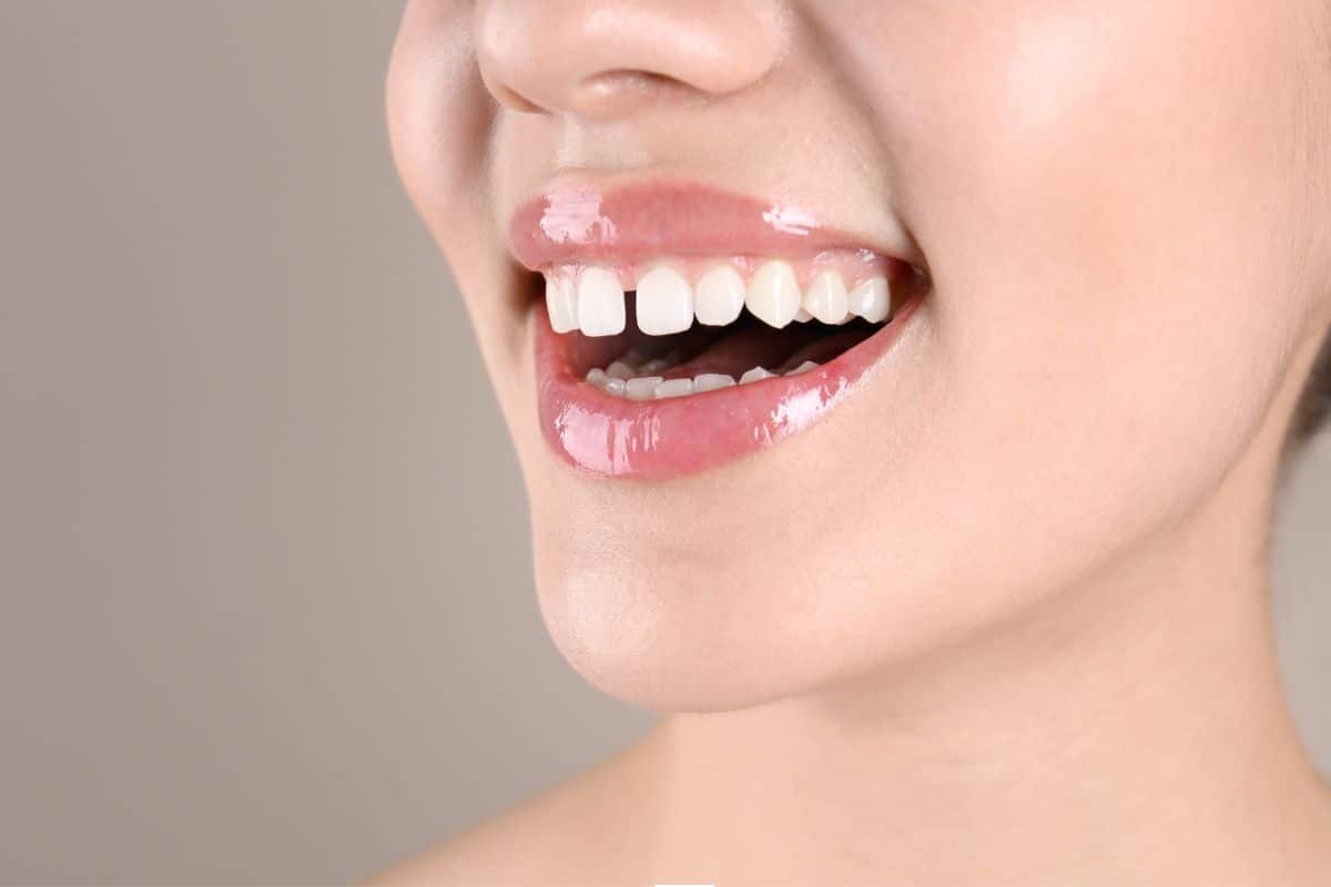 Widely Spaced Teeth
