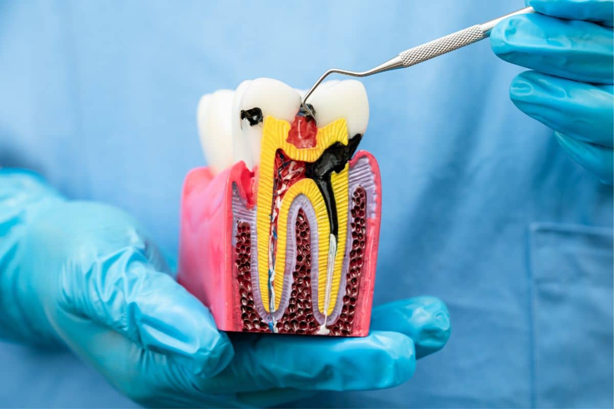 How Root Canal Treatment Can Relieve Severe Tooth Pain