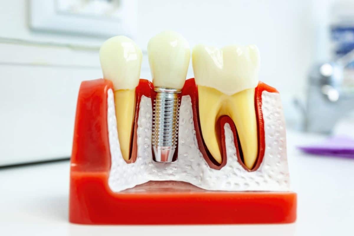 Dental implant model showing tooth structure, internal screw, and gum placement on white surface.